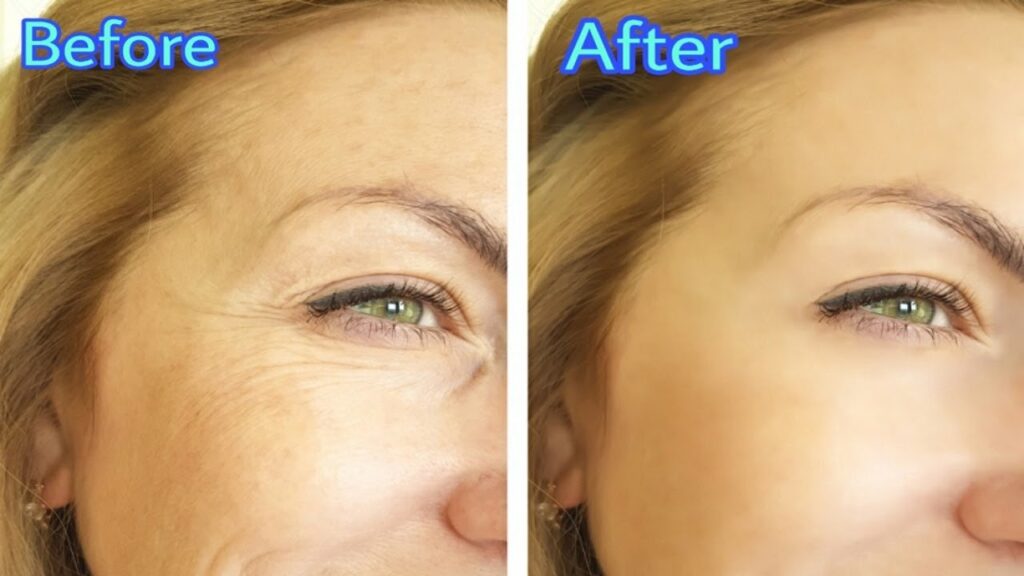 How does botox work